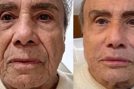 Aos 91 anos, Stênio Garcia faz harmonização facial e comemora: "Quinze anos a menos"